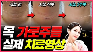 목 가로주름 없애는 법✨ 효과적인 치료법 소개👩‍⚕️ 리얼 시술 후기 공개🎬