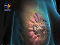 Breast Cancer And Screenings | Sukhibhava | 13th March 2019 | ETV Telangana