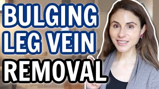 Leg vein removal: varicose veins & spider veins | Dermatologist @DrDrayzday