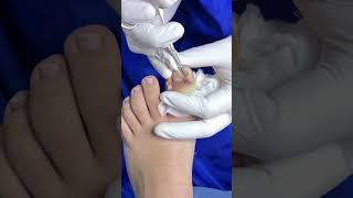 Matricectomia química #ingrown_toenail_surgery #satisfying #podologo #onicocriptosis #uñas