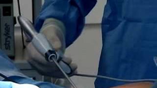 Laparoscopic Retroperitoneal Hysterectomy