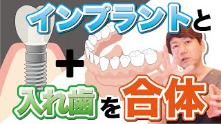 【インプラントと入れ歯の良いとこどり】インプラントオーバーデンチャーで素敵な笑顔になりましょう！