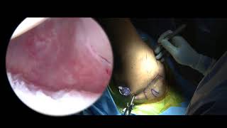 Arthroscopic Pancapsular Shift | Labral Repair | Shoulder Surgeon Vail, CO