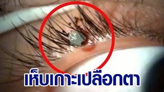 คลิปสุดสยอง เห็บกัดเปลือกตาคน หมอคีบออกให้ แนะอย่าดึงออกเอง