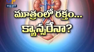 Sukhibhava - మూత్రంలో రక్తం క్యాన్సరేనా? - 4th July 2016 - సుఖీభవ