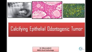 Calcifying Epithelial Odontogenic Tumor