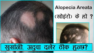 Alopecia Areata (खोईरो) के हो? || खुर्सानी, अदुवा दलेर ठीक हुन्छ? || Dr. Rupak Ghimire