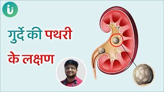 किडनी में पथरी/स्टोन के होते हैं ये 7 लक्षण | 7 Symptoms Of Kidney Stone in Hindi | Dr ayush pandey