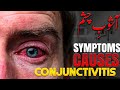 conjunctivitis | آشوب چشم | pink eye | how to treat at home | saniya meraj