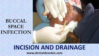 Incision and Drainage of Buccal space infection by Dr. Raman Dhungel