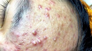 Big Cystic Acne Blackheads Extraction Blackheads, Whiteheads Removal Pimple Popping -mini ep