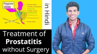 Treatment of Prostatitis without Surgery - Dr. Vinod Kumar | Hindi