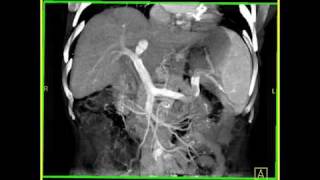 Abdomen: Liver: Cirrhosis: 3D: Volume rendering of a cirrhotic liver with collaterals