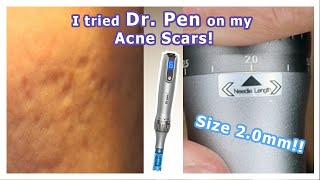 I used Dr. Pen on my acne scars | Starting with 2.0mm size!!