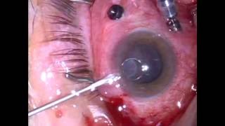 Removing Silicone Oil from the Anterior Chamber