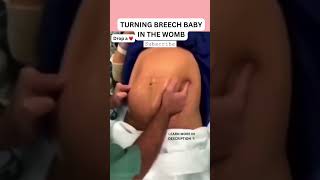 Turning breech baby in the womb #shorts #birth #shortsfeed #baby