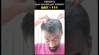 #AskDrJohnWatts | DAY - 111 of ASHOK’S HAIR TRANSPLANT JOURNEY | #besthairtransplant #drjohnwatts