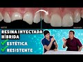 Carillas de Resina Inyectada Híbridas ¡Estéticas pero Resistentes! | Una excelente alternativa