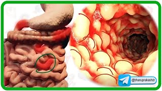 Inflammatory bowel disease (IBD) : Crohn's disease and Ulcerative colitis