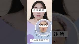 Z波下巴抽脂，甩掉雙下巴，打造小V臉 #尚凌診所