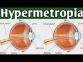 Hypermetropia | Long Sightedness