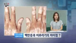 여름철 유행하는 몸속 곰팡이 '어루러기' [07/25] / YTN 웨더