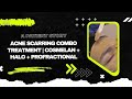 A PATIENT STORY | ACNE SCARRING COMBO TREATMENT | COSMELAN + HALO + PROFRACTIONAL | Dr. Jason Emer