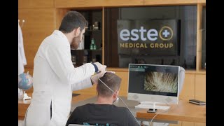 6 months hair transplant results with Este Medical Group