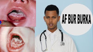 AF BUR BURKA CARUURTA AMA CAWEEBKA (ORAL THRUSH)Dr Fahad Al Attas