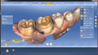 CEREC SW 4.4: Tutorial 3 -  Model Phase #1