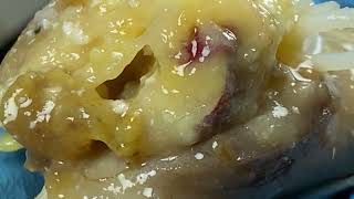 Sharp Ingrown Trimmed! Professional Pedicure DR LEE’S ULTIMATE ZITPOPPER! 無心で見れる動画  M10101 1179