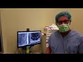 dr. chappuis explains treatment for central disc herniation with disc fusion