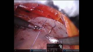 Robotic Spigelian Hernia Repair with Inguinal and Femoral Hernia