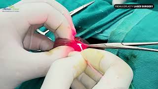 Frenuloplasty Laser Treatment in Gurgaon | Penile Frenuloplasty in Delhi NCR  | Frenuloplasty Doctor