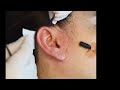 본격귀청소 8 사촌동생1 오른쪽귀 real ear cleaning