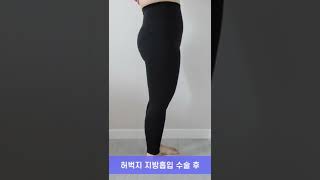 흔한 직딩의 허벅지 지흡 3개월차 수술 전/후 변화 1탄!!!