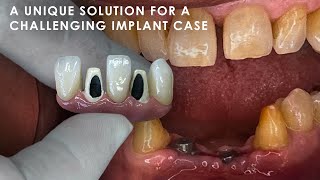 A Unique Solution for a Challenging Implant Case