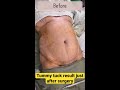 ঝুলে যাওয়া পেট টানটান করার উপায় tummy tuck surgery in bangladesh abdomen liposuction