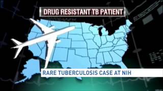 Rare tuberculosis case at NIH