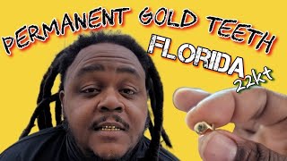 Everything about permanent gold teeth!