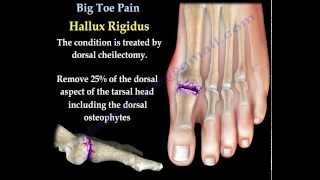 Big Toe Pain - Everything You Need To Know - Dr. Nabil Ebraheim