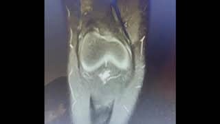 Large osteochondral defect in a child's knee