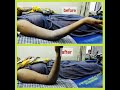 Case of Elbow joint stiffness after surgery, recovered by matrix rhythm therapy