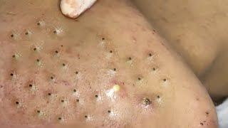 Blackheads of Pubescent Male Matients at Sac Dep Spa