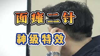 董氏奇穴：秘方面瘫二针，神级特效组穴，临床应用讲解！刘红云董氏针灸教学