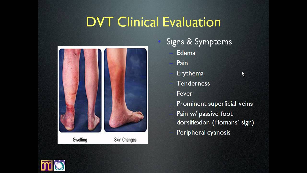 Internal Medicine Grand Rounds -- Deep Vein Thrombosis.mp4 - YouTube