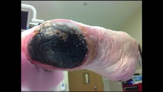 diabetic Gangrene