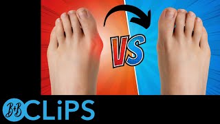 How To Fix A Bunion In 5 Steps (B&B Clips)