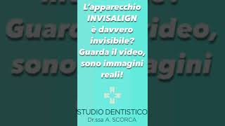 Apparecchio invisibile Bari Invisalign