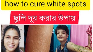 ছুলি দূর করার উপায় | how to cure white spots | #mahuaskatha #whitespots #skincare